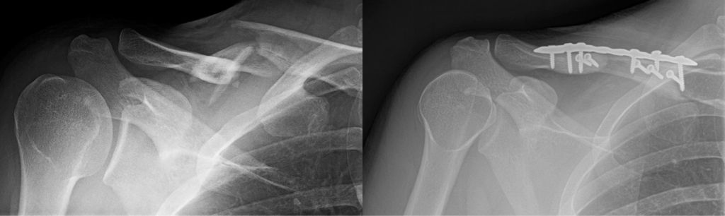 Clavicle fracture x ray by Orthopaedic Associates of Muskegon